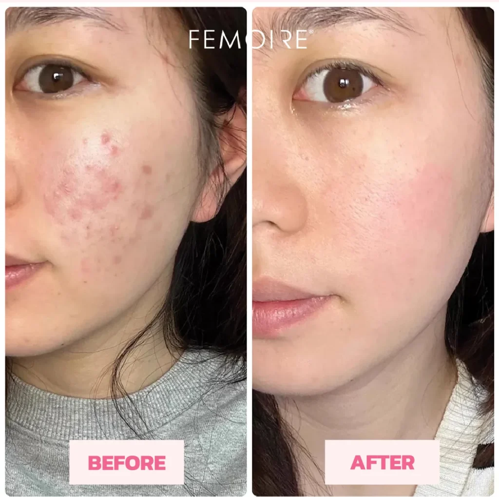 Testimonial 1 : Acne Reduction
