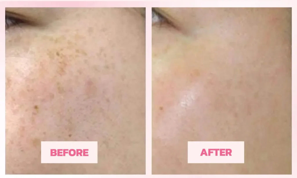 Testimonial 2 : Pigmentation/Freckles Faded