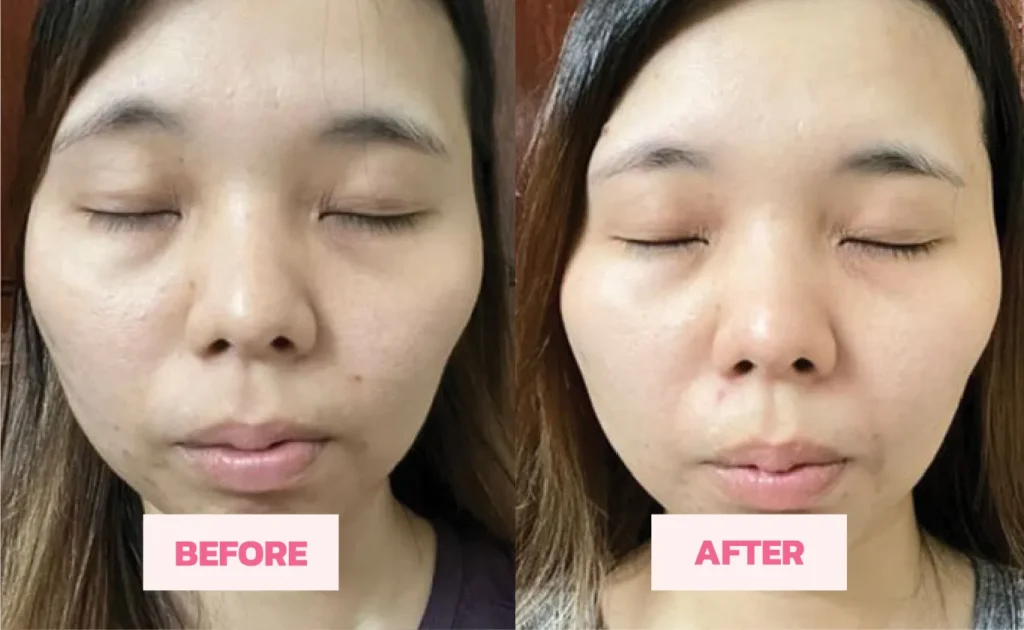 Testimonial 5 : Fine line reduction